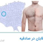 مراکز لیزر مو آقایان در صادقیه