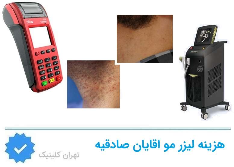 هزینه لیزر موهای زائد آقایان در صادقیه چقدر است؟
