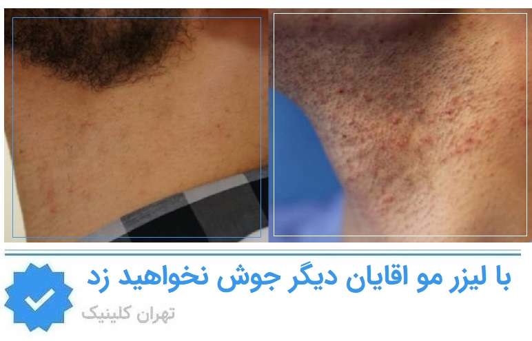 مزایای لیزر مو آقایان