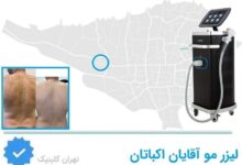 لیزر مو آقایان اکباتان