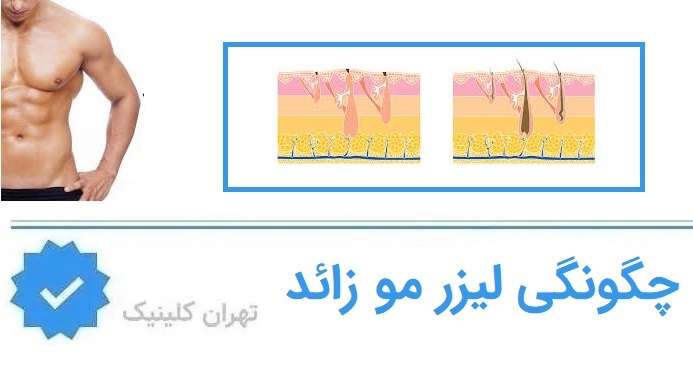 چند جلسه لیزر برای رسیدن به نتیجه ایده‌آل لازم است؟