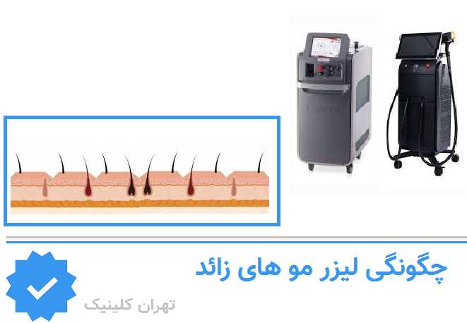 چگونگی انجام لیزر برای آقایان در مراکز جنت آباد