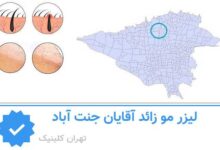 لیزر مو زائد اقایان جنت آباد
