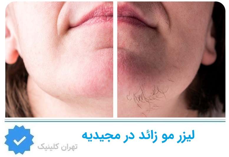 عکس لیزر مو زائد مجیدیه