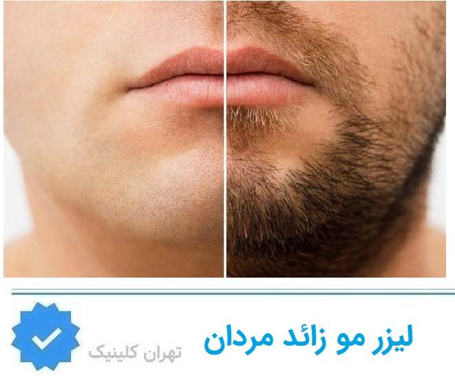 لیزر مو زائد مردان مجیدیه