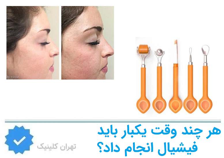هر چند وقت یکبار باید فیشیال انجام داد؟ 