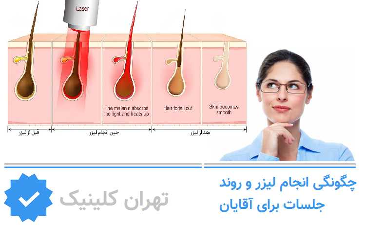چگونگی انجام لیزر و روند جلسات برای آقایان