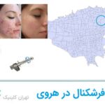 لیزر فرشکنال در هروی