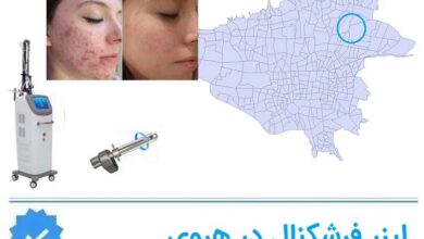 لیزر فرشکنال در هروی