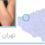 لیزر مو زائد شهران