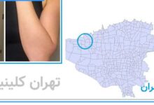 لیزر مو زائد شهران