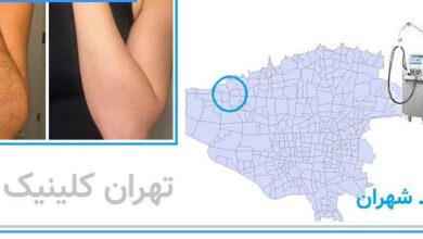 لیزر مو زائد شهران
