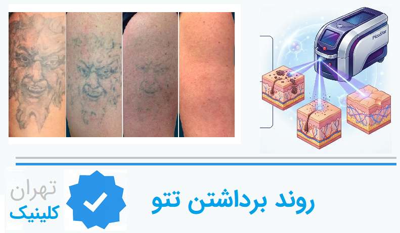 عملکرد لیزر در تخریب ذرات رنگی