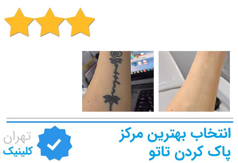 بهترین مراکز پاک کردن تاتو و خالکوبی در پاسداران تهران