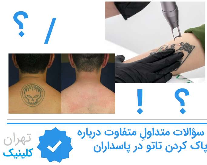 سؤالات متداولِ متفاوت درباره پاک کردن تاتو در پاسداران