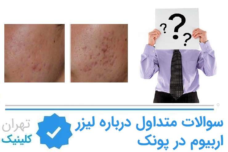سوالات متداول درباره لیزر اربیوم در پونک