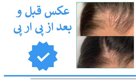 عکس قبل و بعد از پی ار پی