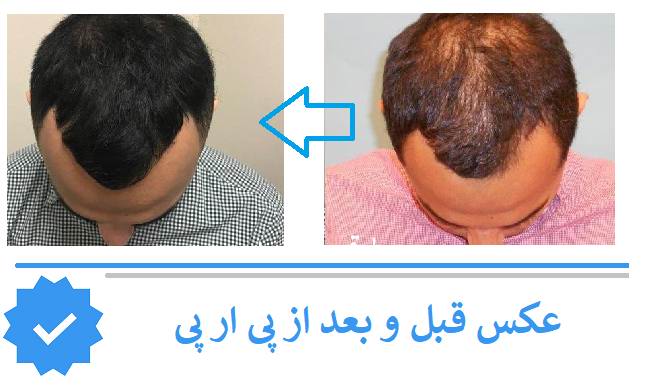 عکس قبل و بعد از پی ار پی