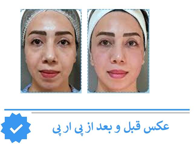 عکس قبل و بعد پی ار پی شریعتی