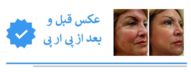 عکس قبل و بعد از پی ار پی در بلوار فردوس