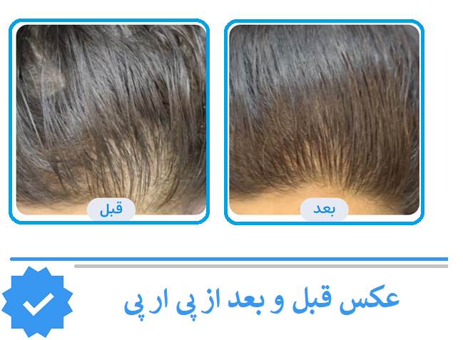 عکس قبل و بعد از پی ار پی