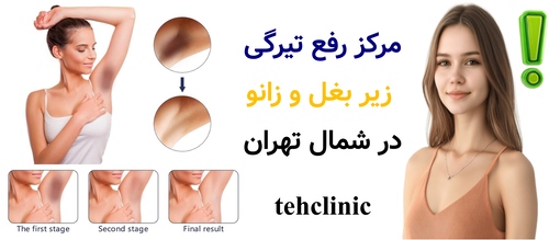 مرکز رفع تیرگی زیر بغل و زانو در شمال تهران