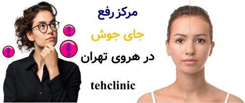مرکز رفع جای جوش در هروی تهران