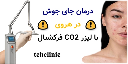 درمان جای جوش در هروی با لیزر CO2 فرکشنال