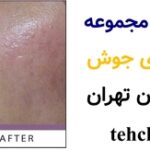 بهترین مجموعه رفع جای جوش پاسداران تهران