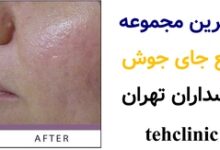 بهترین مجموعه رفع جای جوش پاسداران تهران