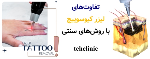 تفاوتهای لیزر کیوسوییچ با روشهای سنتی