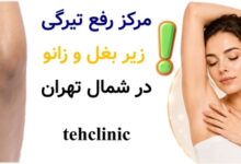 مرکز رفع تیرگی زیر بغل و زانو در شمال تهران