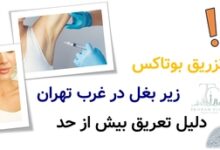 تزریق بوتاکس زیر بغل در غرب تهران + دلیل تعریق بیش از حد
