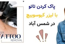 پاک کردن تاتو با لیزر کیوسوییچ در شمس آباد