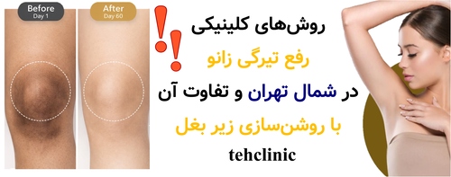 روش‌های کلینیکی رفع تیرگی زانو در شمال تهران و تفاوت آن با روشن‌سازی زیر بغل