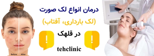 درمان انواع لک صورت (لک بارداری، آفتاب) در قلهک
