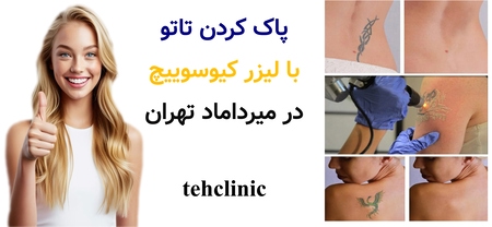 پاک کردن تاتو با لیزر کیوسوییچ در میرداماد تهران