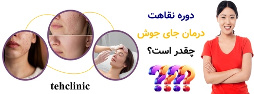 دوره نقاهت درمان جای جوش چقدر است؟