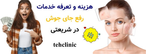 هزینه و تعرفه خدمات رفع جای جوش در شریعتی